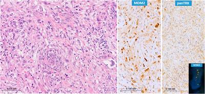 NTRK amplification occurs frequently in pan-TRK immunopositive dedifferentiated liposarcomas